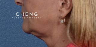 Hidden Patients Before & After Gallery - Patient 186097 - Image 6
