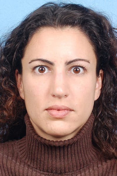 Brow Lift Before & After Gallery - Patient 978632 - Image 1