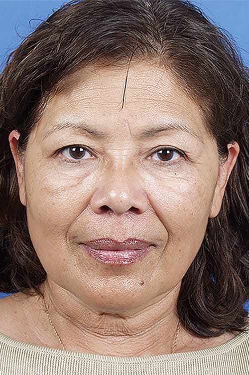 Brow Lift Before & After Gallery - Patient 404518 - Image 1