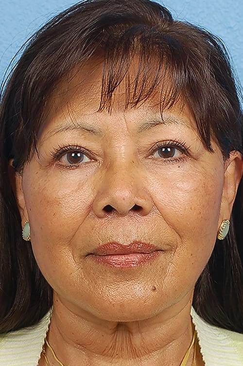 Brow Lift Before & After Gallery - Patient 404518 - Image 2