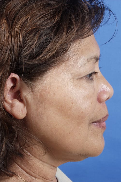 Brow Lift Before & After Gallery - Patient 404518 - Image 3