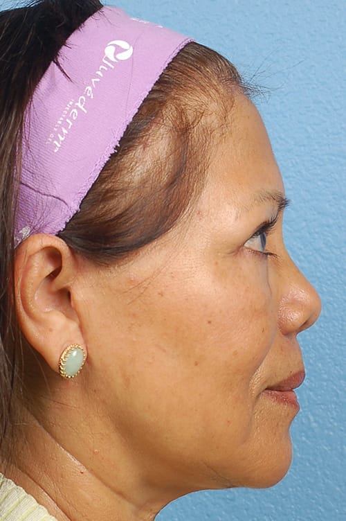Brow Lift Before & After Gallery - Patient 404518 - Image 4