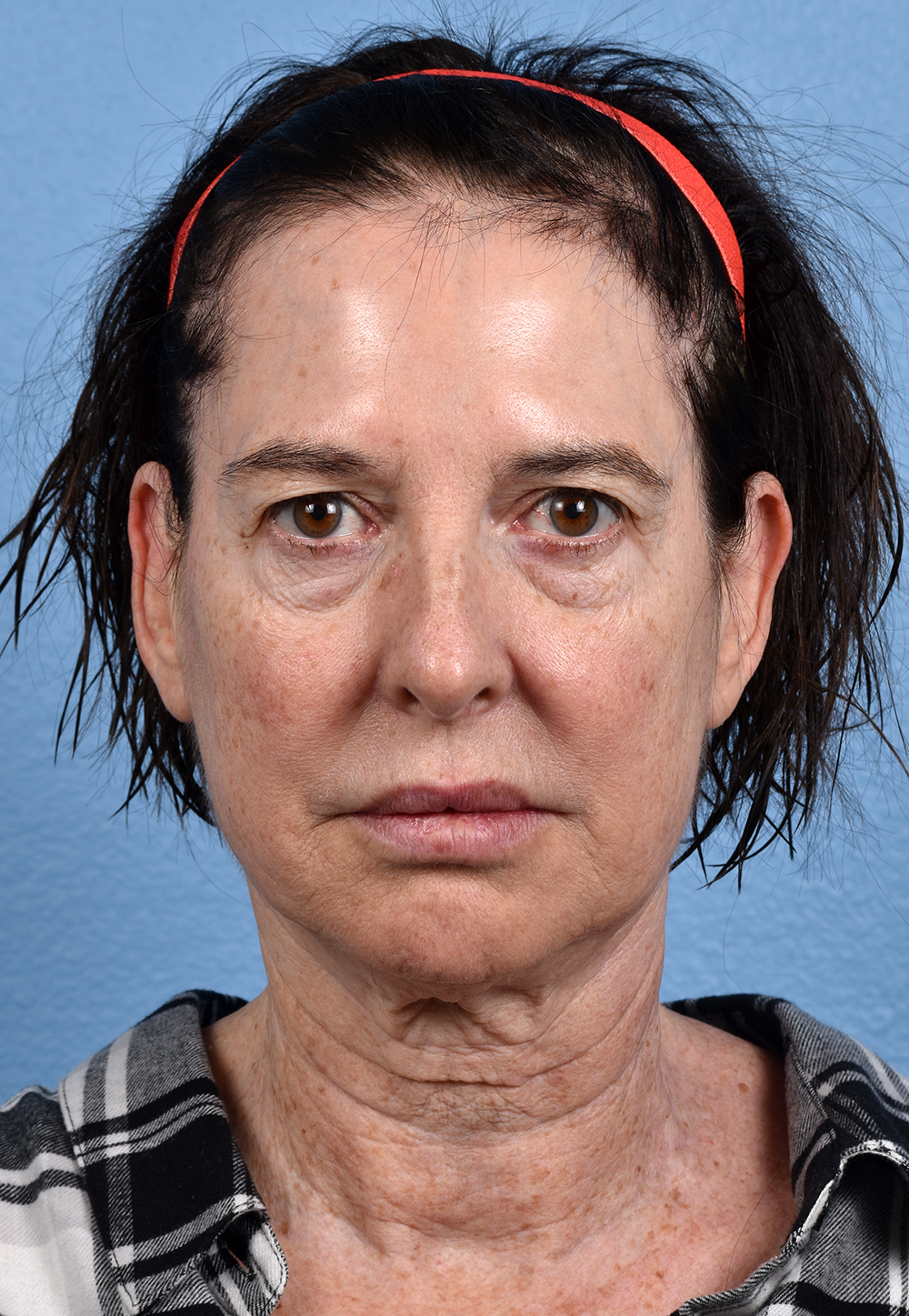 Brow Lift Before & After Gallery - Patient 488051 - Image 1
