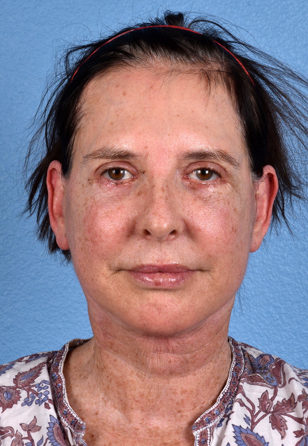 Brow Lift Before & After Gallery - Patient 488051 - Image 2