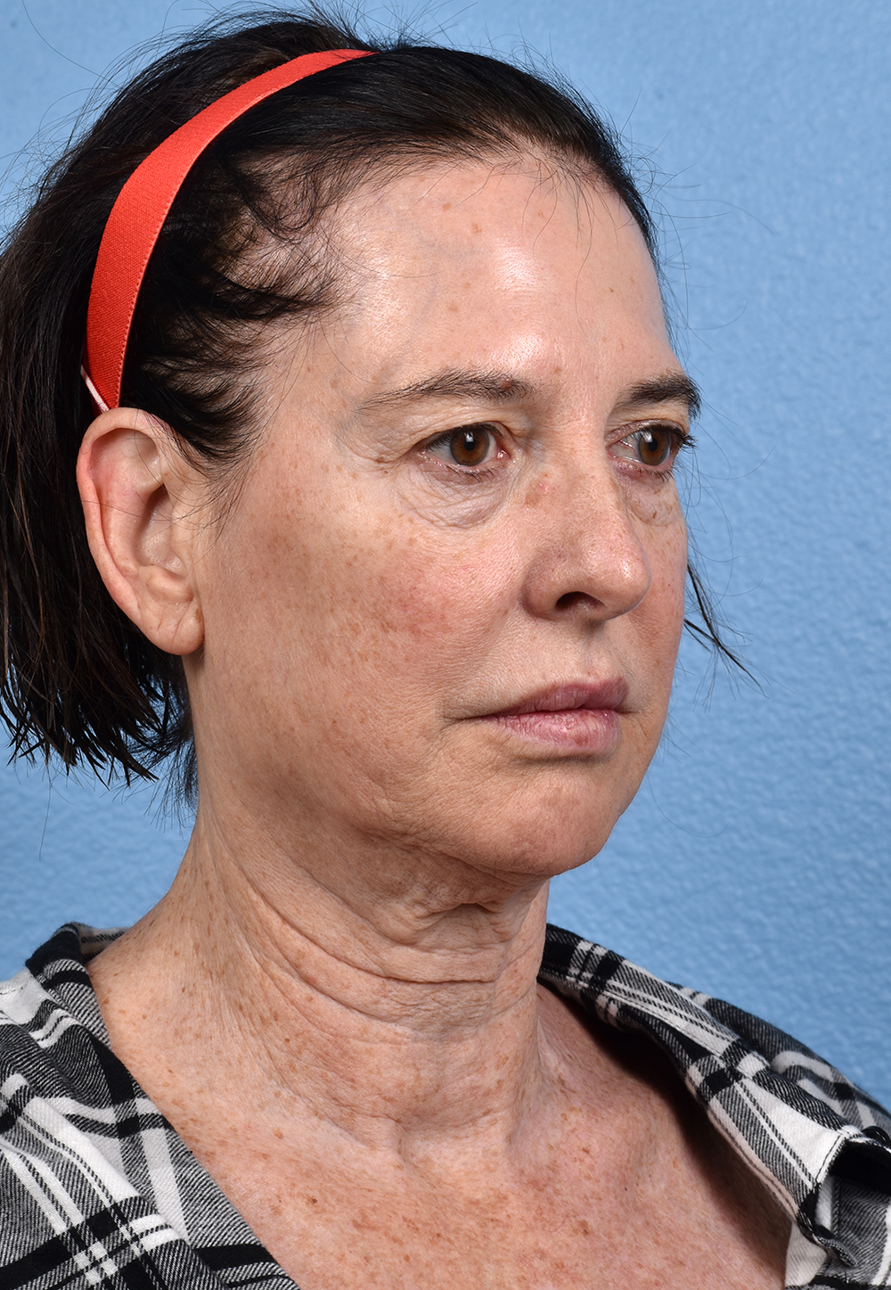 Brow Lift Before & After Gallery - Patient 488051 - Image 3