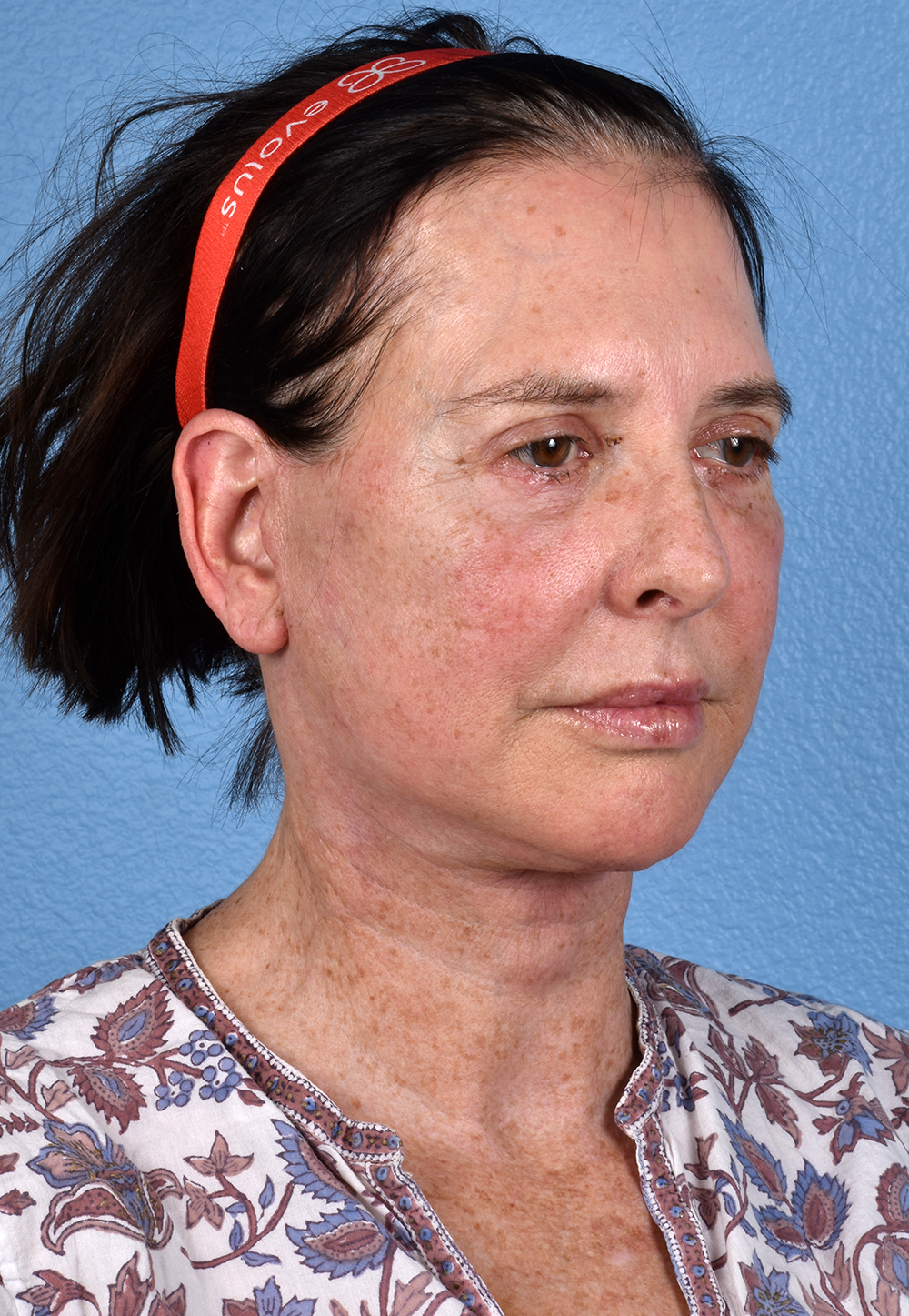 Brow Lift Before & After Gallery - Patient 488051 - Image 4