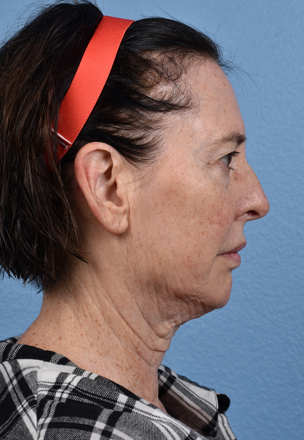 Brow Lift Before & After Gallery - Patient 488051 - Image 5