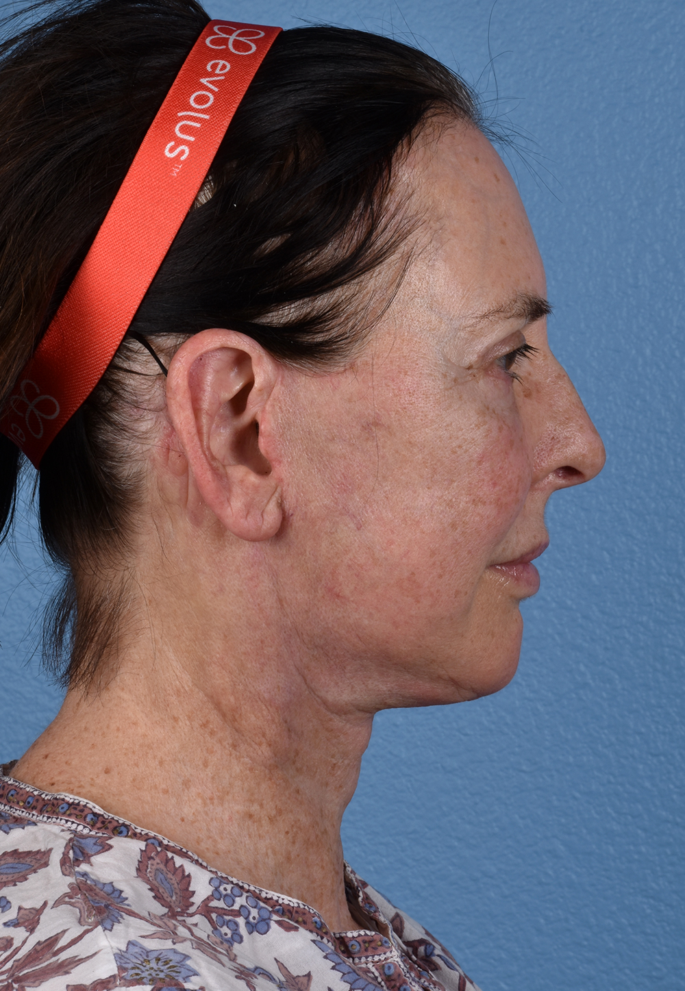 Brow Lift Before & After Gallery - Patient 488051 - Image 6