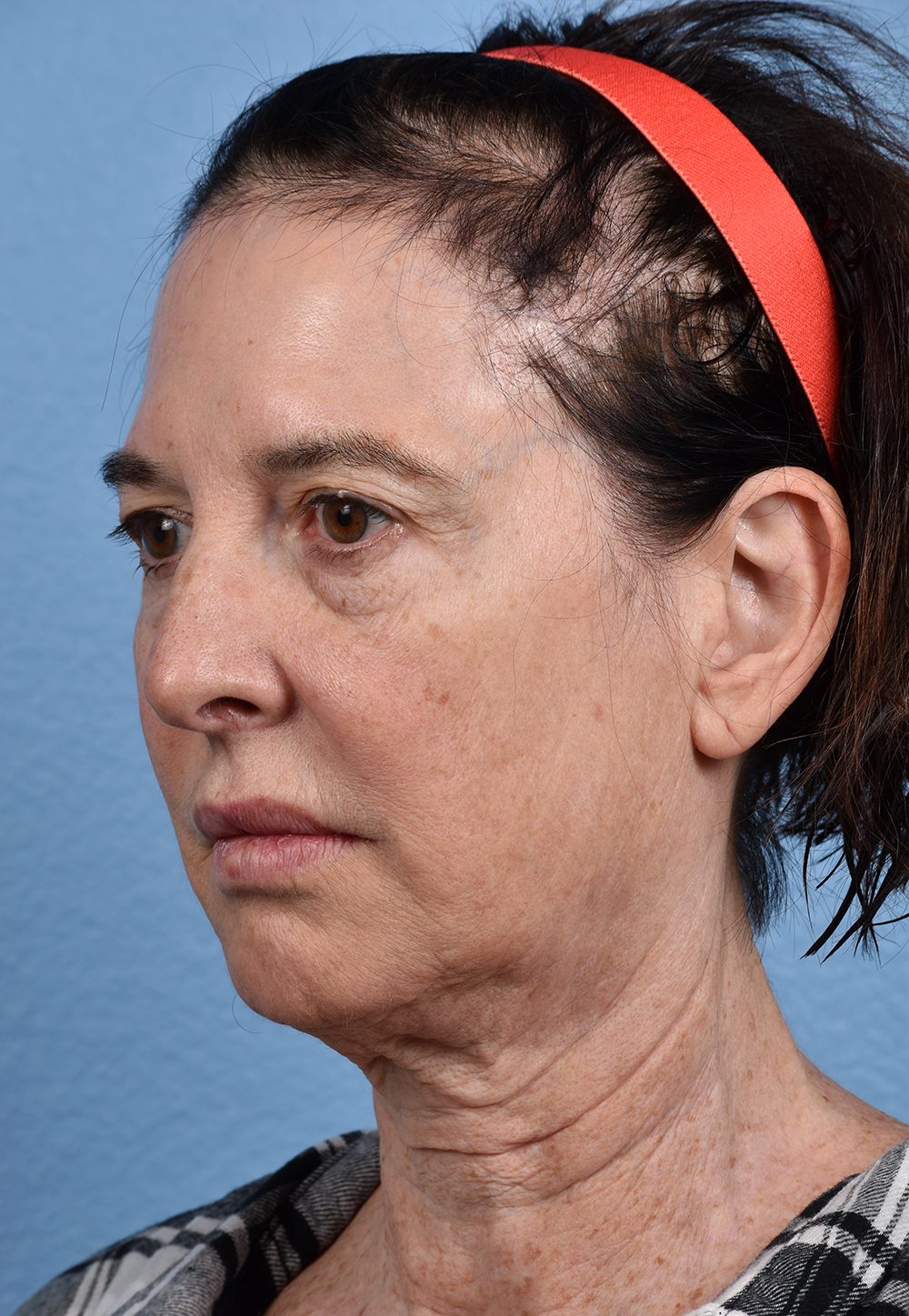 Brow Lift Before & After Gallery - Patient 488051 - Image 7