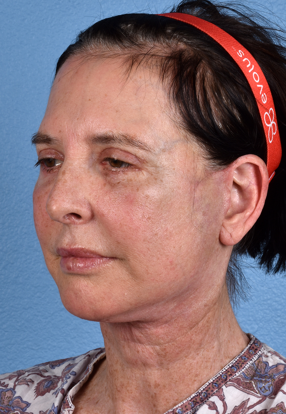 Brow Lift Before & After Gallery - Patient 488051 - Image 8