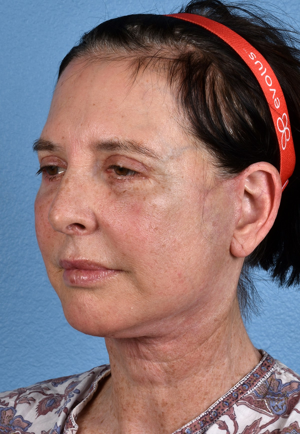 Brow Lift Before & After Gallery - Patient 488051 - Image 8