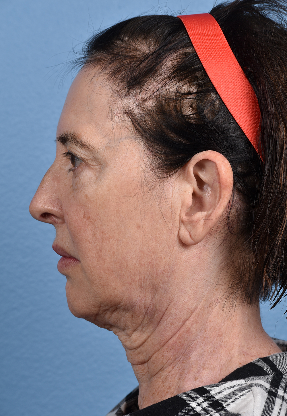 Brow Lift Before & After Gallery - Patient 488051 - Image 9
