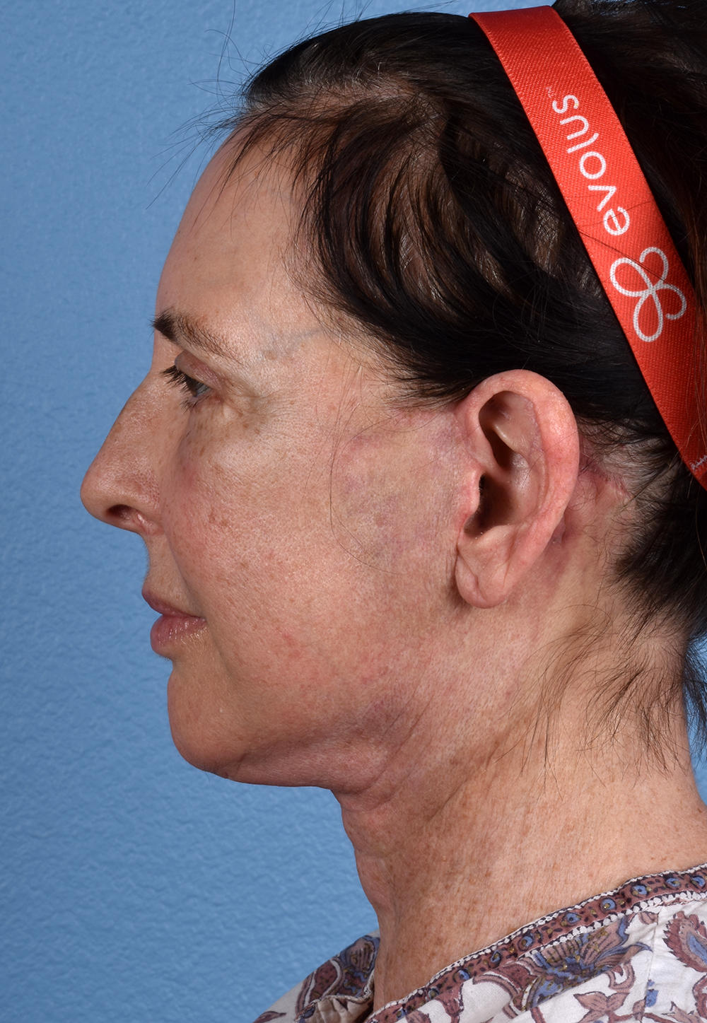 Brow Lift Before & After Gallery - Patient 488051 - Image 10