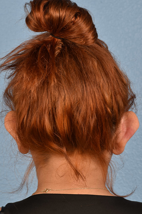 Otoplasty Before & After Gallery - Patient 302523 - Image 1