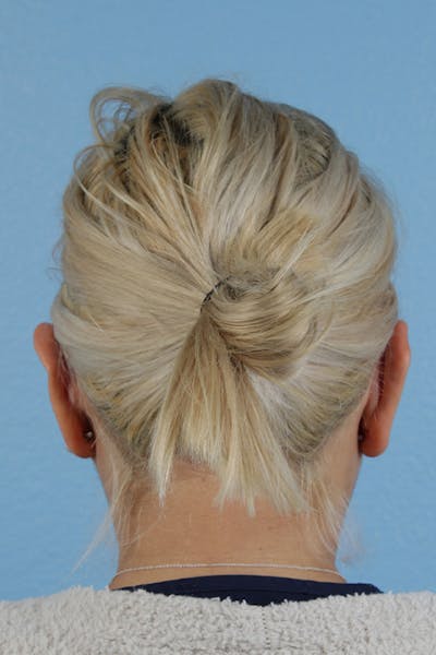 Otoplasty Before & After Gallery - Patient 302523 - Image 2