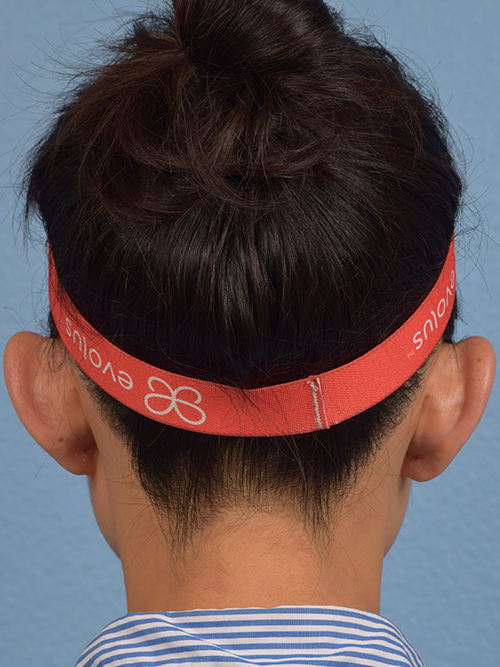 Otoplasty Before & After Gallery - Patient 260468 - Image 1