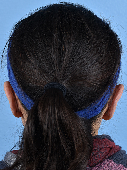 Otoplasty Before & After Gallery - Patient 260468 - Image 2