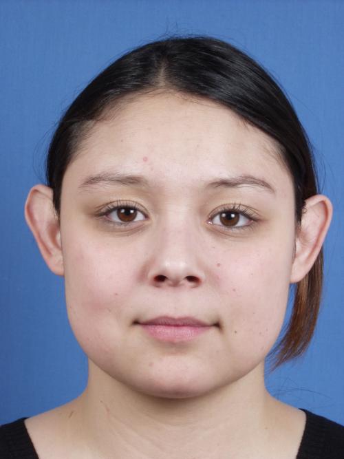 Otoplasty Before & After Gallery - Patient 316708 - Image 1