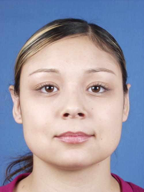 Otoplasty Before & After Gallery - Patient 316708 - Image 2