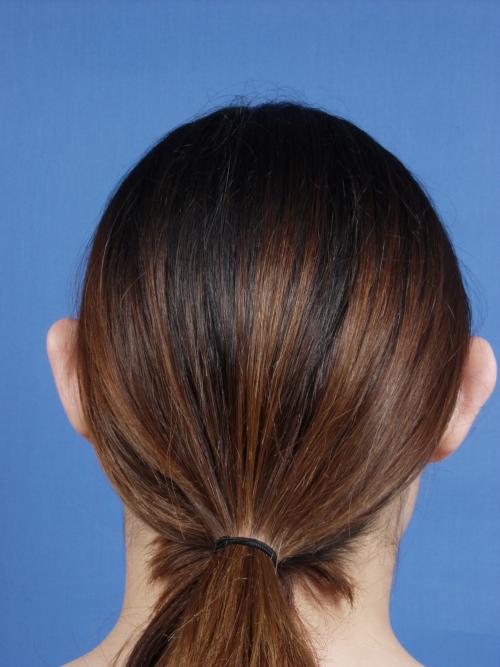 Otoplasty Before & After Gallery - Patient 316708 - Image 3