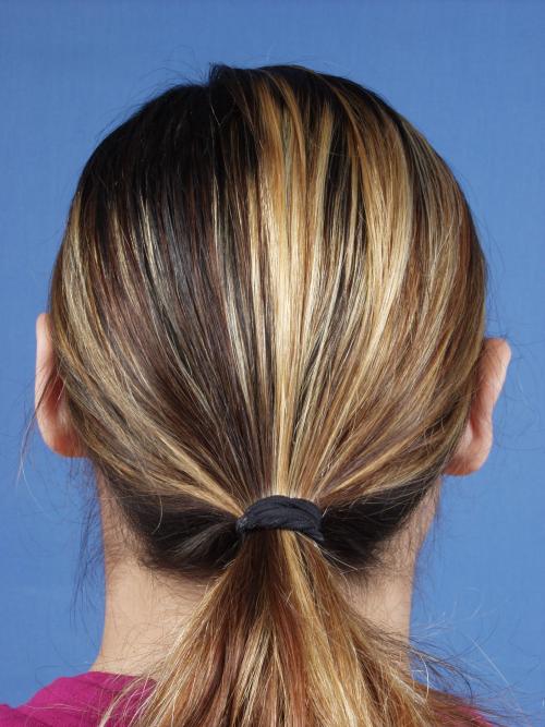 Otoplasty Before & After Gallery - Patient 316708 - Image 4