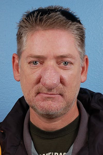 Rhinophyma Before & After Gallery - Patient 169254 - Image 1