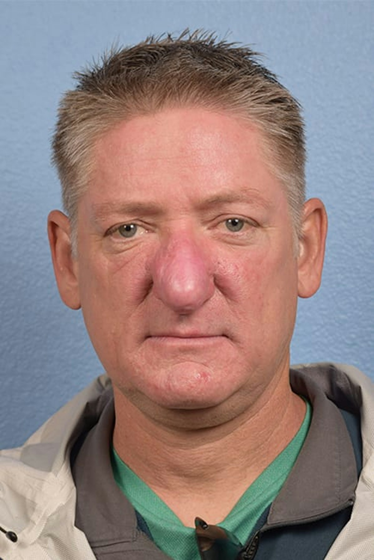 Rhinophyma Before & After Gallery - Patient 169254 - Image 2