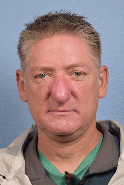 Rhinophyma Before & After Gallery - Patient 169254 - Image 2