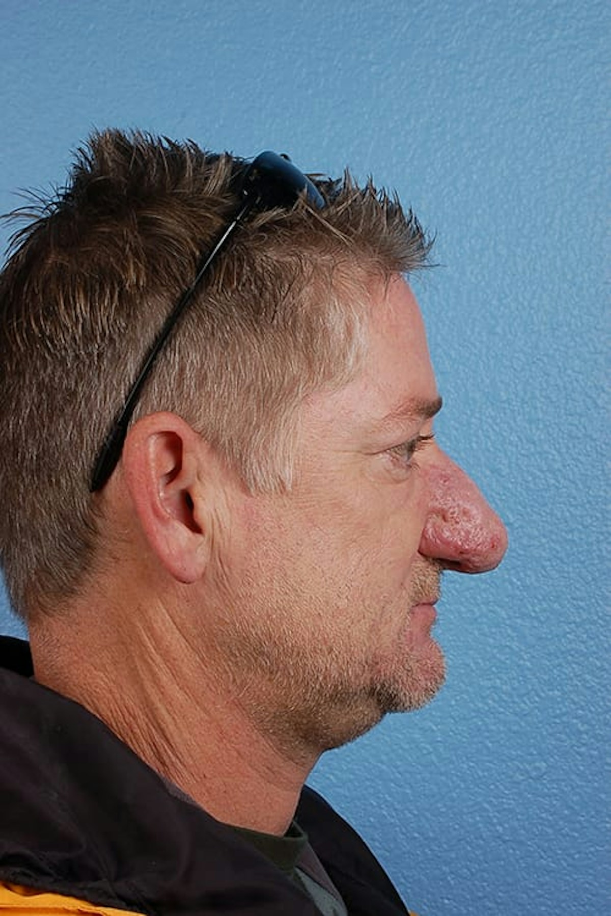 Rhinophyma Before & After Gallery - Patient 169254 - Image 3