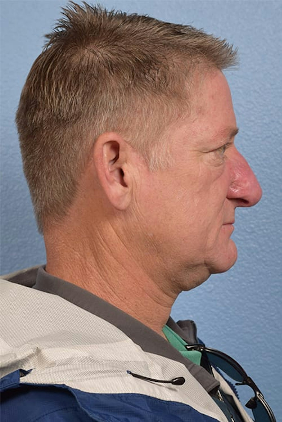 Rhinophyma Before & After Gallery - Patient 169254 - Image 4