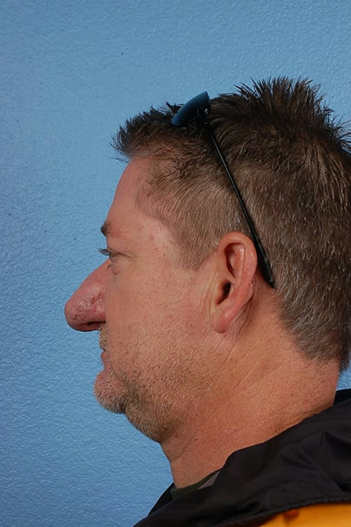 Rhinophyma Before & After Gallery - Patient 169254 - Image 5
