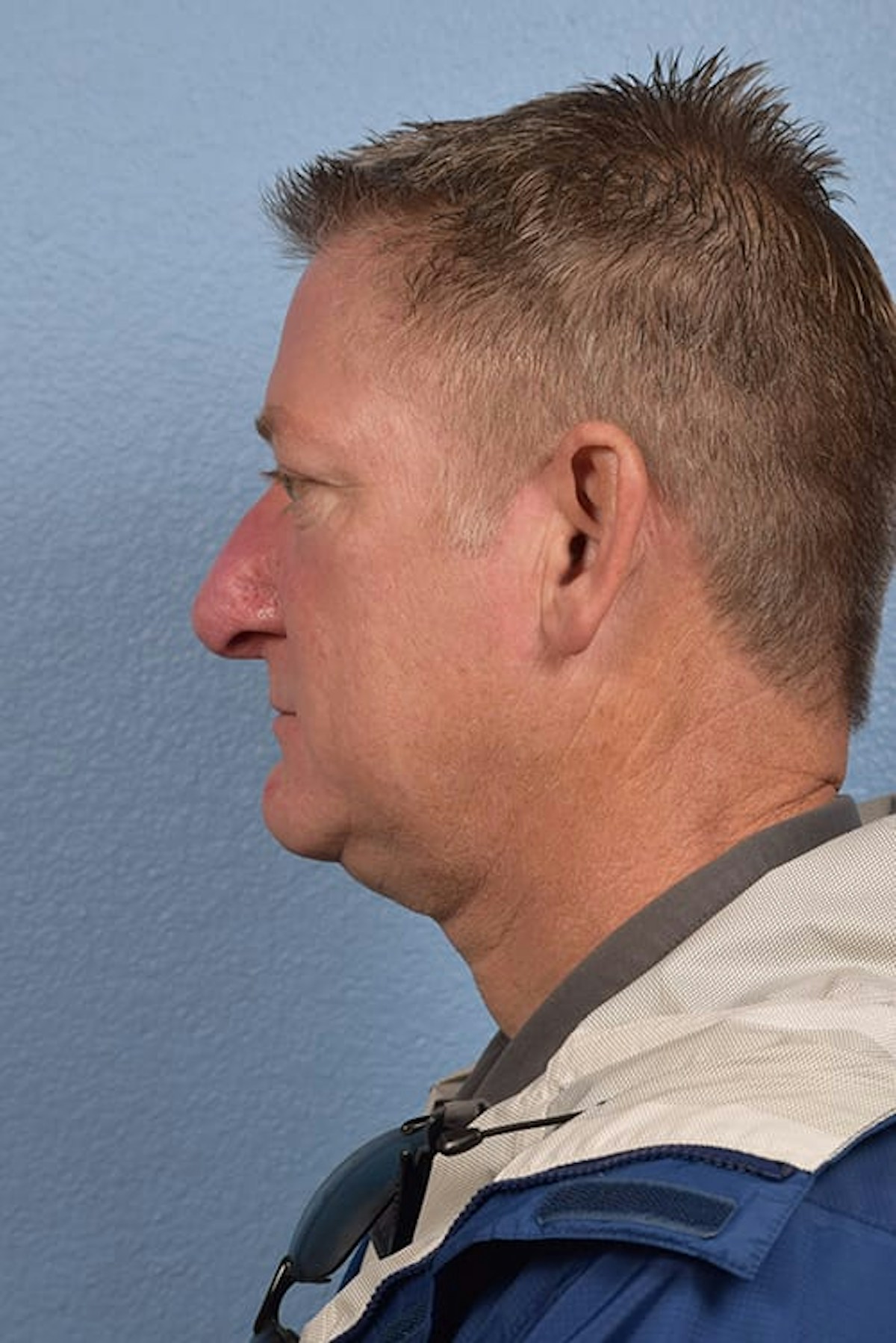 Rhinophyma Before & After Gallery - Patient 169254 - Image 6