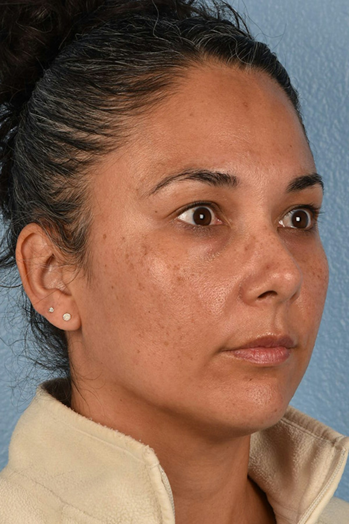Lip Lift Before & After Gallery - Patient 191794 - Image 1