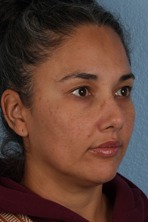 Hidden Patients Before & After Gallery - Patient 162458 - Image 2