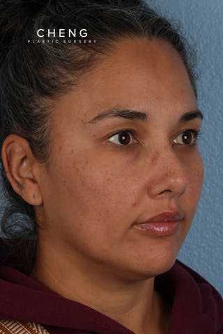 Hidden Patients Before & After Gallery - Patient 162458 - Image 2