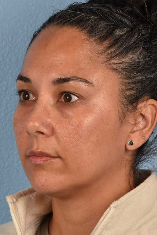 Hidden Patients Before & After Gallery - Patient 162458 - Image 3