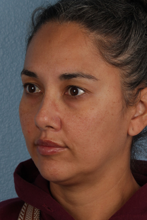 Hidden Patients Before & After Gallery - Patient 162458 - Image 4