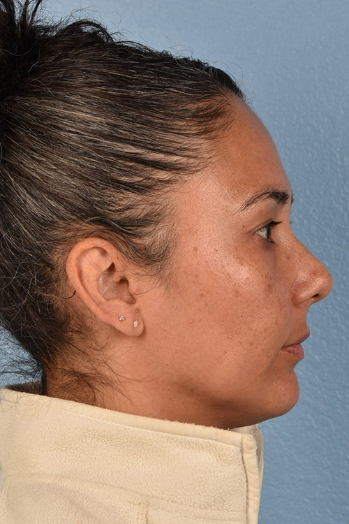 Hidden Patients Before & After Gallery - Patient 162458 - Image 5