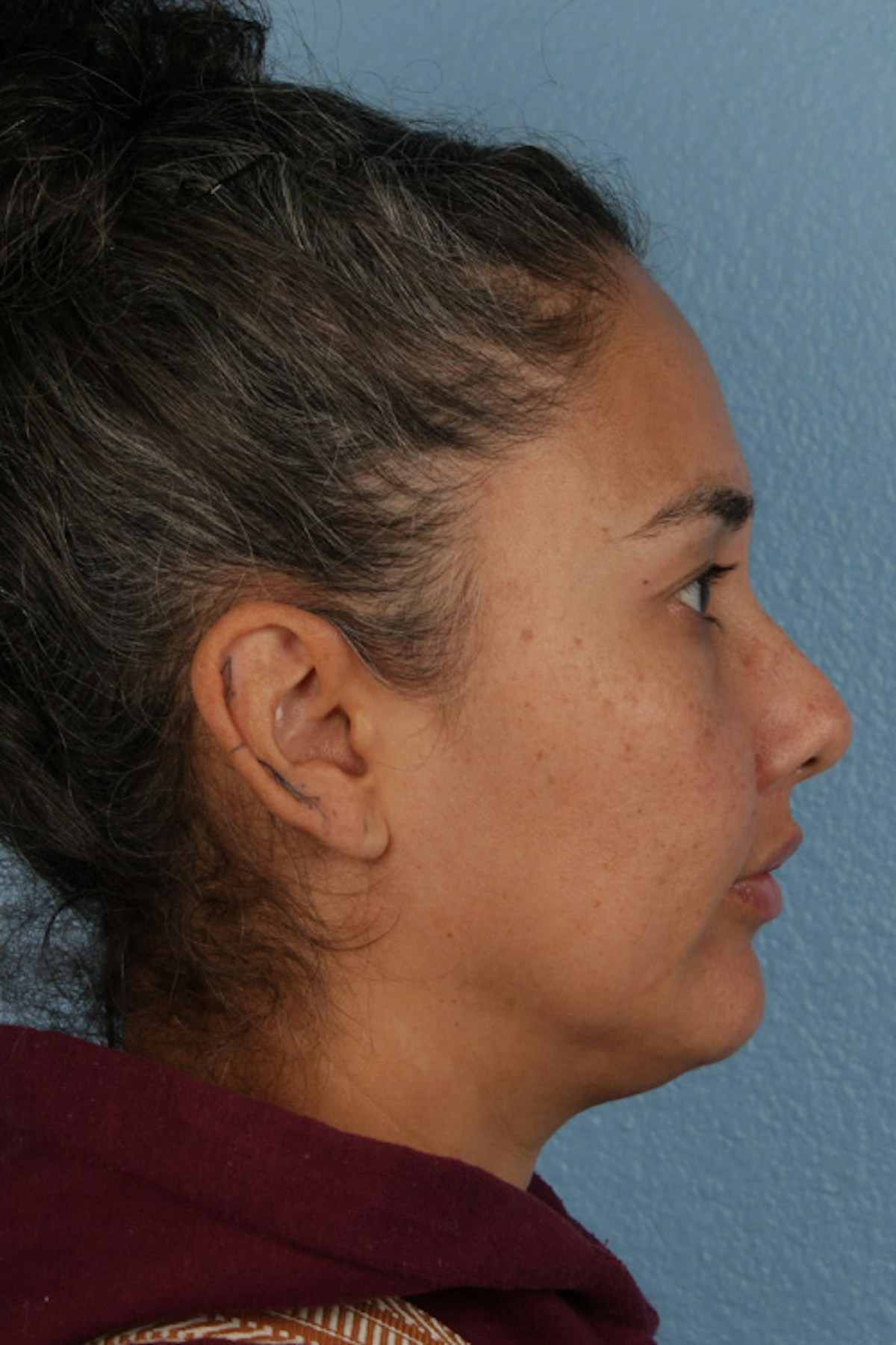 Lip Lift Before & After Gallery - Patient 191794 - Image 6