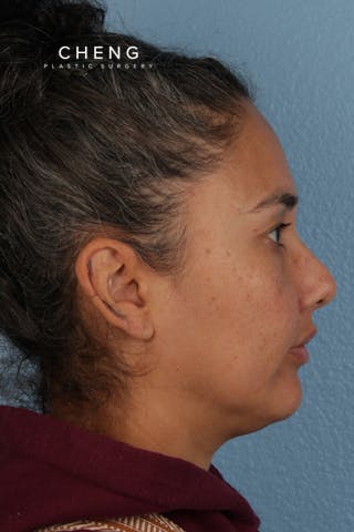 Hidden Patients Before & After Gallery - Patient 162458 - Image 6