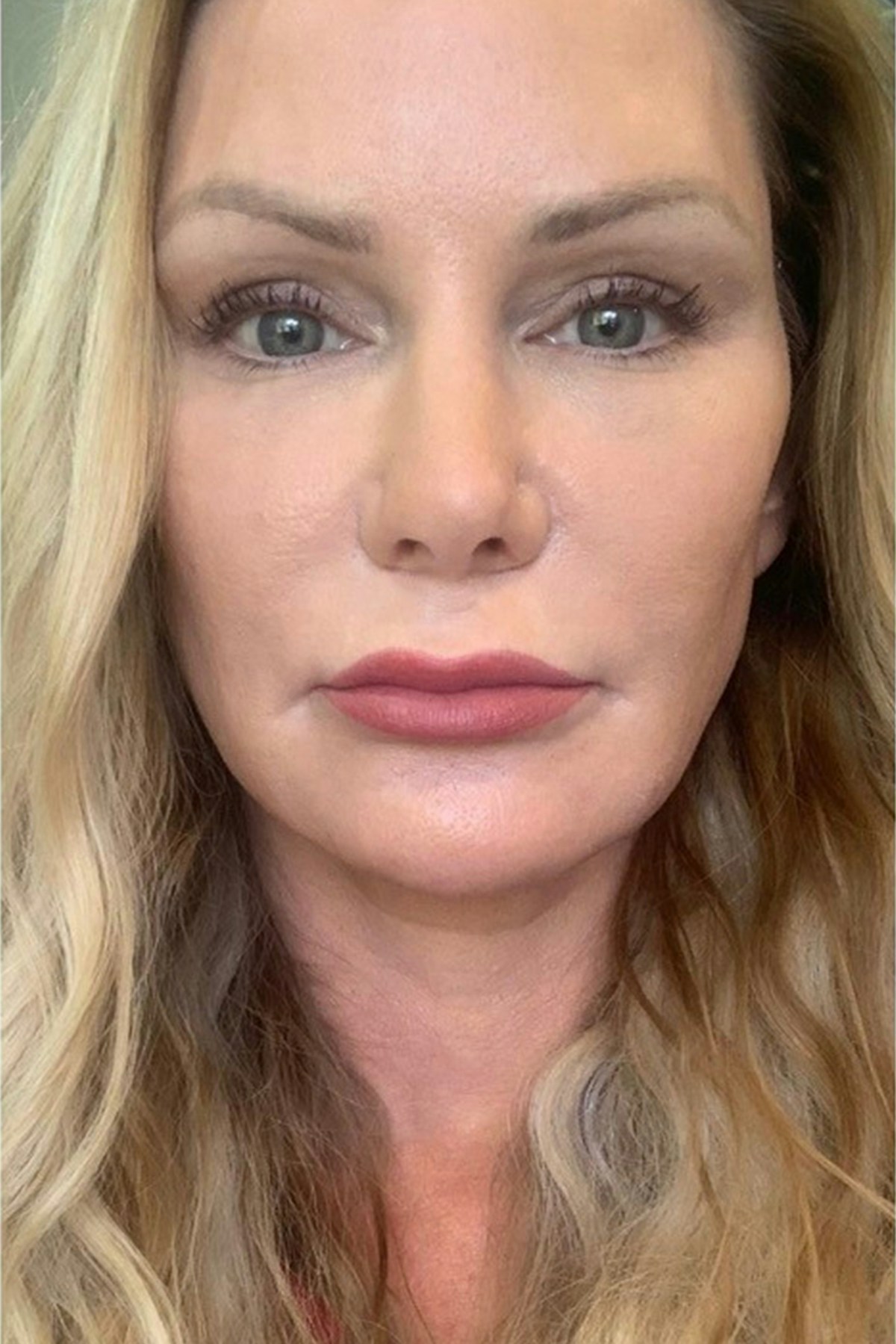 Lip Lift Before & After Gallery - Patient 100570 - Image 1