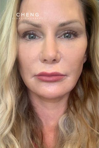Hidden Patients Before & After Gallery - Patient 357343 - Image 1