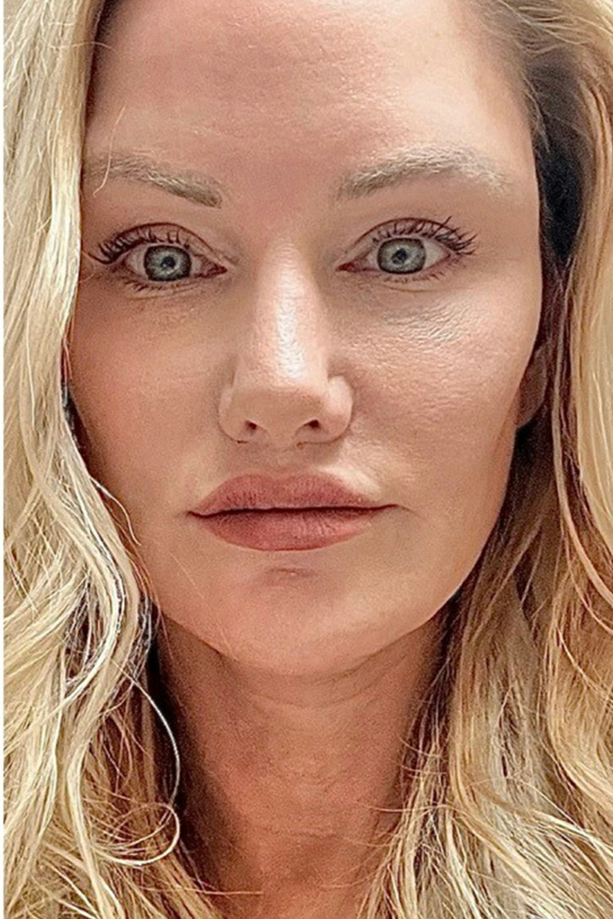 Lip Lift Before & After Gallery - Patient 100570 - Image 2