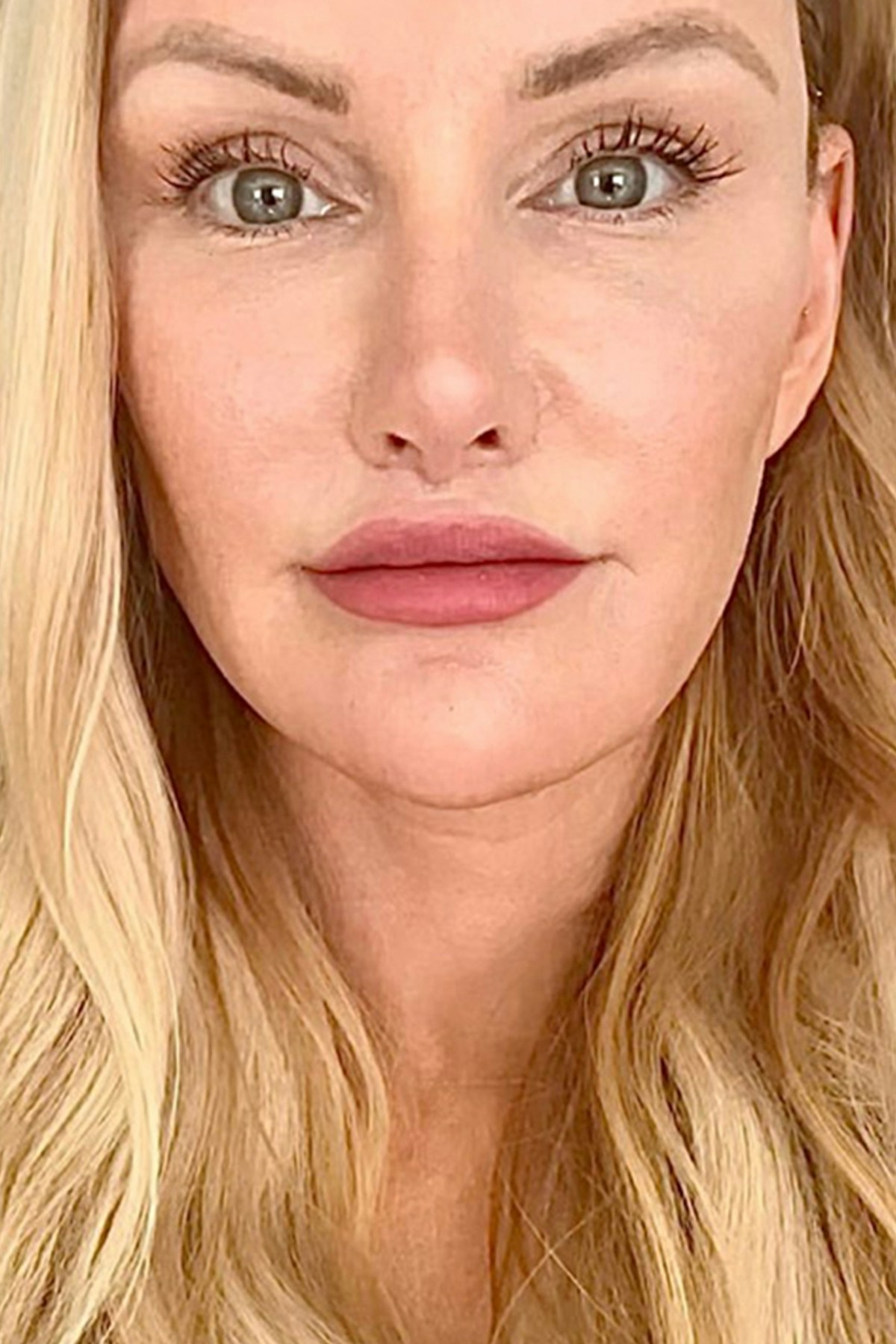 Lip Lift Before & After Gallery - Patient 100570 - Image 4