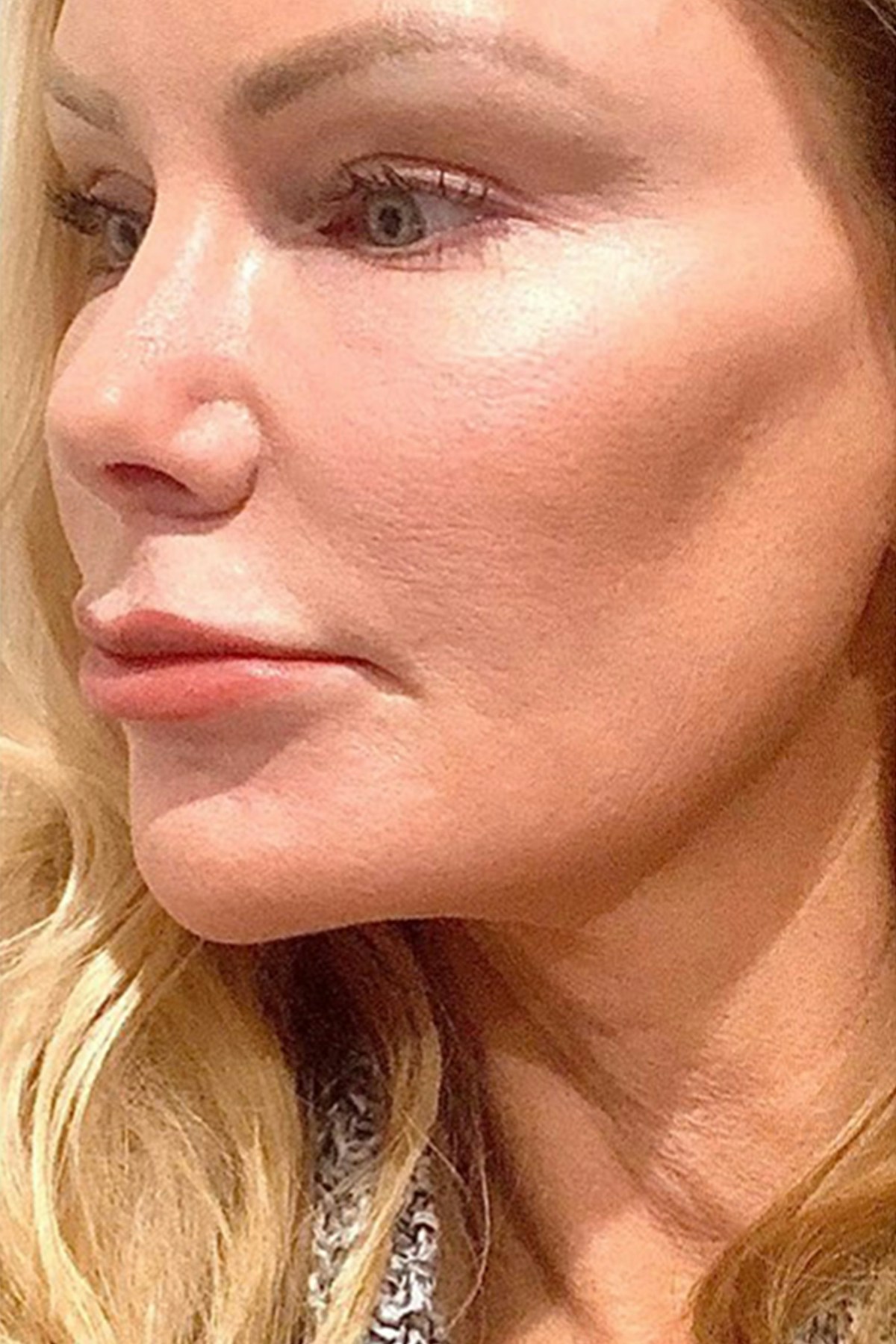 Lip Lift Before & After Gallery - Patient 100570 - Image 5