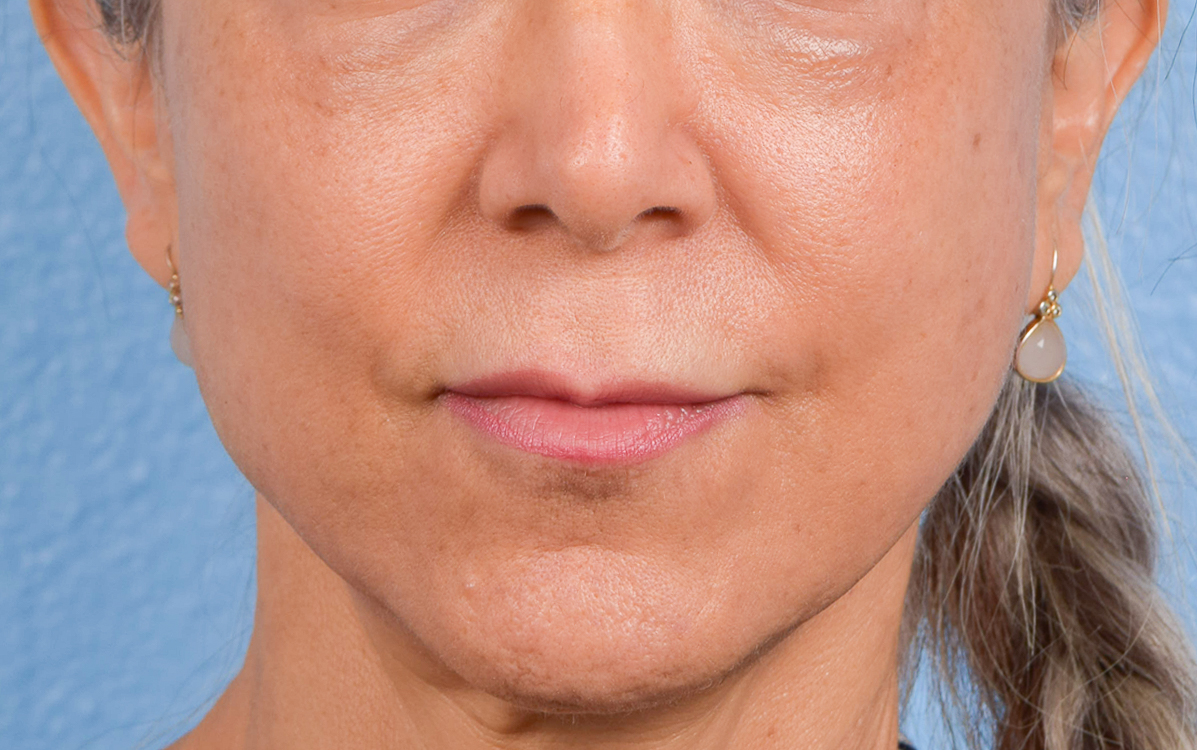 Lip Lift Before & After Gallery - Patient 376152 - Image 1