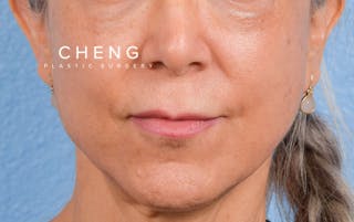 Hidden Patients Before & After Gallery - Patient 372181 - Image 1