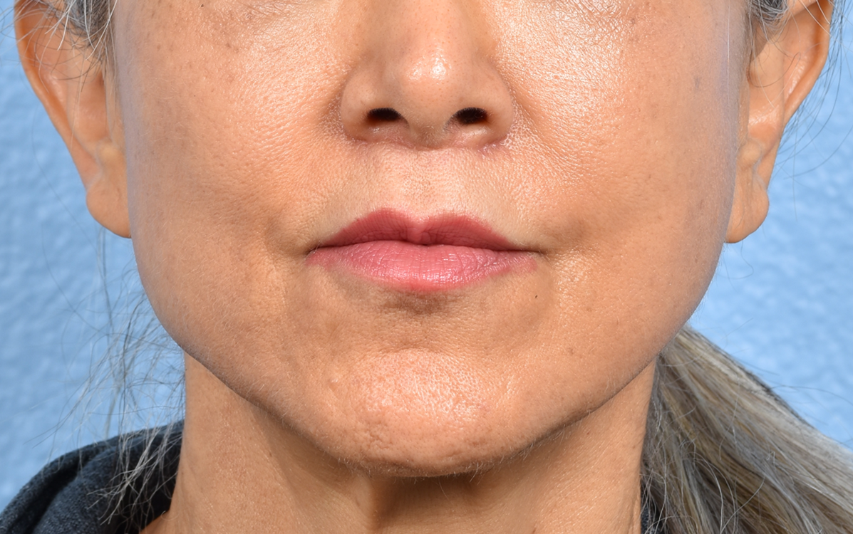 Lip Lift Before & After Gallery - Patient 376152 - Image 2