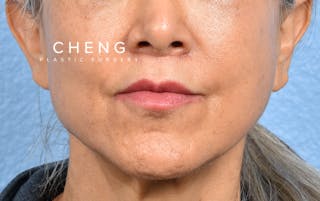Hidden Patients Before & After Gallery - Patient 372181 - Image 2