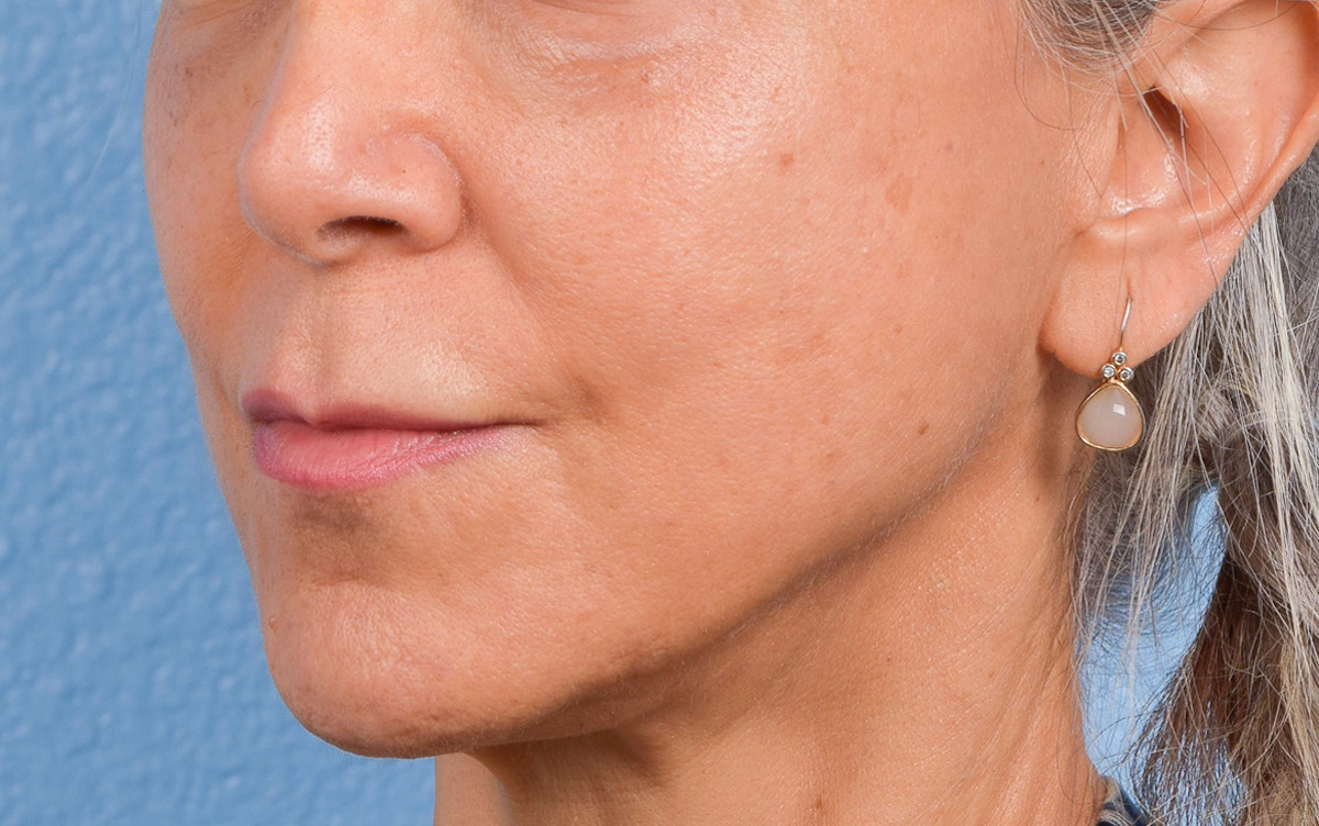 Lip Lift Before & After Gallery - Patient 376152 - Image 3